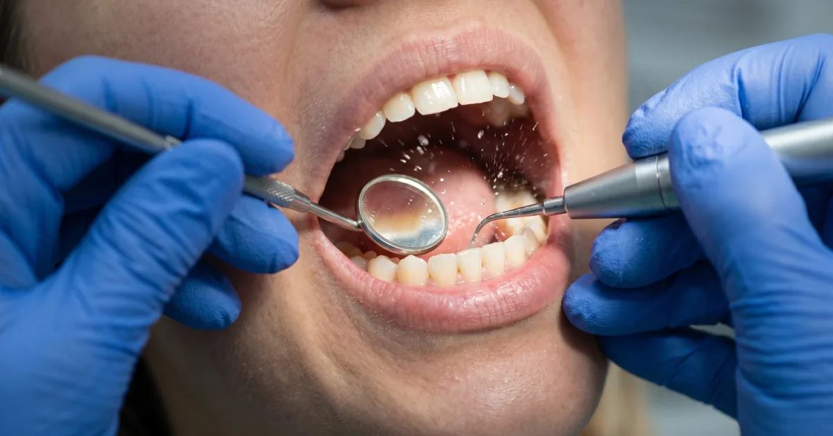 Limpieza dental profunda en Argüelles, Madrid: cuándo y por qué la necesitas